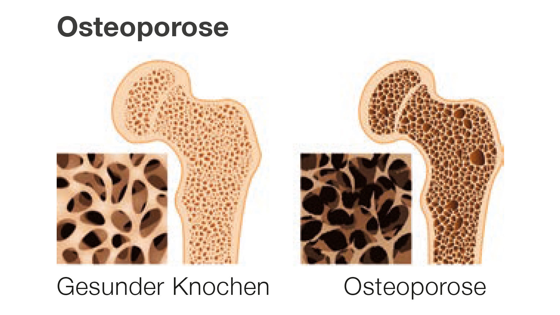Osteoporose | Bildquelle: DiSEE e.V.